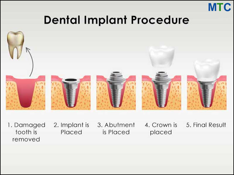 Dental Implant procedure