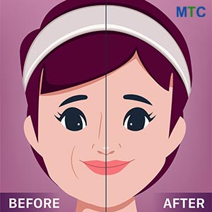 MACS lift vector- before & after 