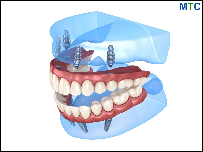 All-on-4 Dental Implants