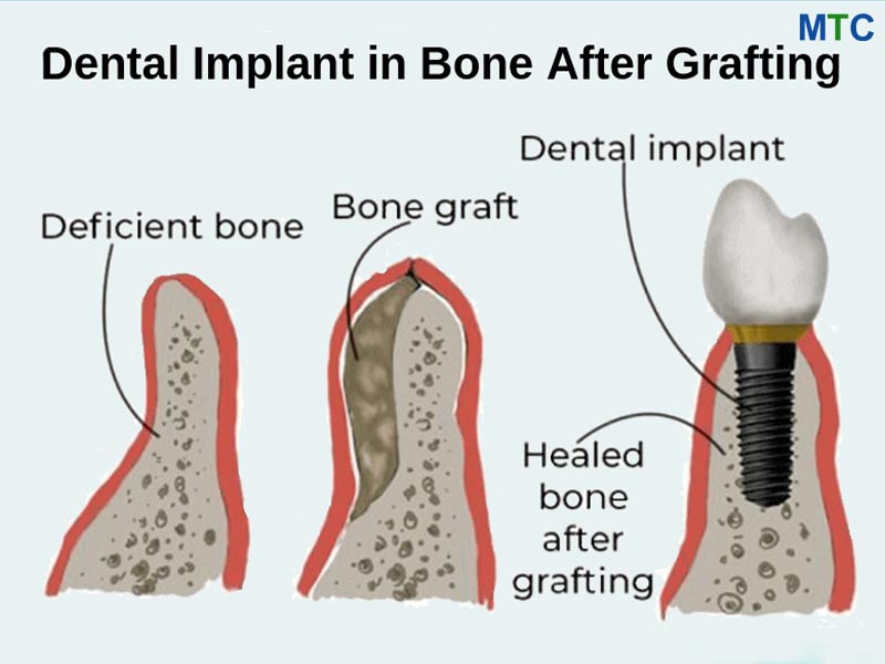 Bone Grafting for Dental Implants