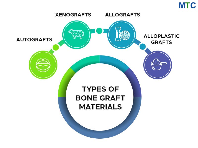 Types of bone Grafts