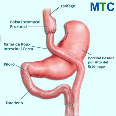 Gastric Bypass Procedure