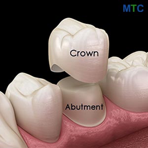 Dental Crowns in Cluj Napoca, Romania