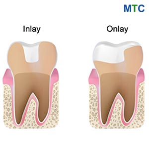 Inlay Onlay