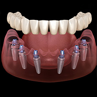 All on 6 Dental Implants