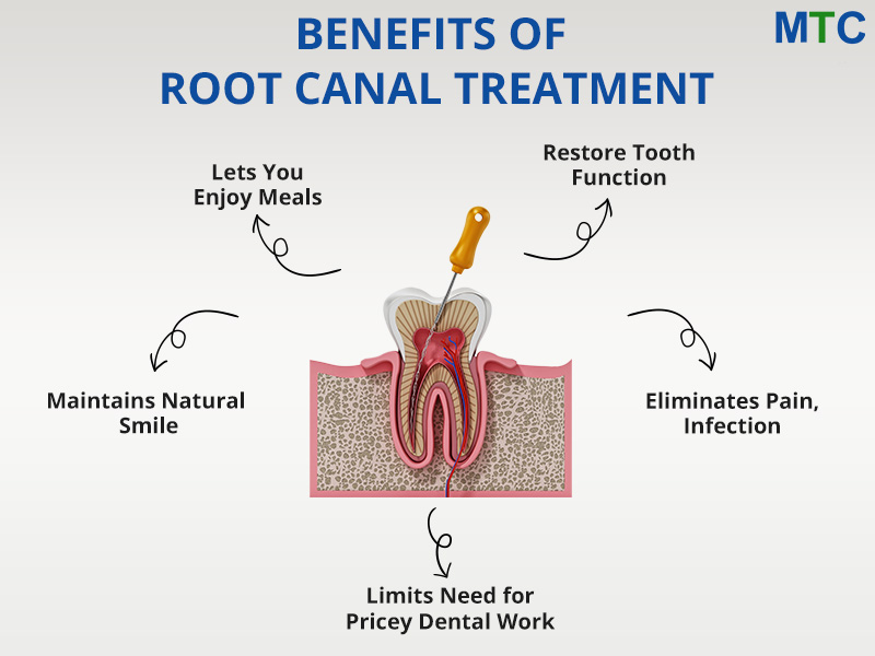 Benefits of Root Canal Treatment