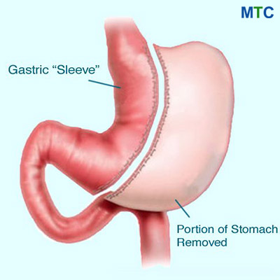 Gastric Sleeve in Turkey