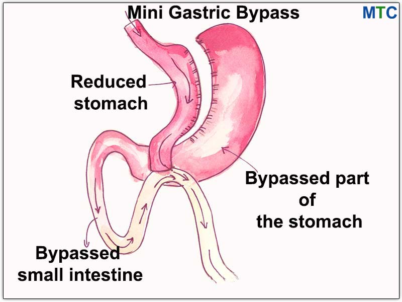 Mini Gastric Bypass Procedure