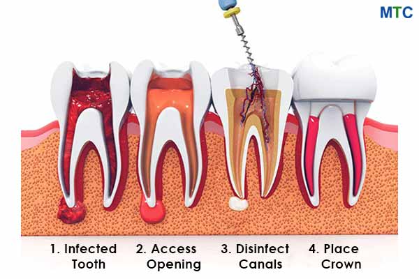 Root Canal Treatment