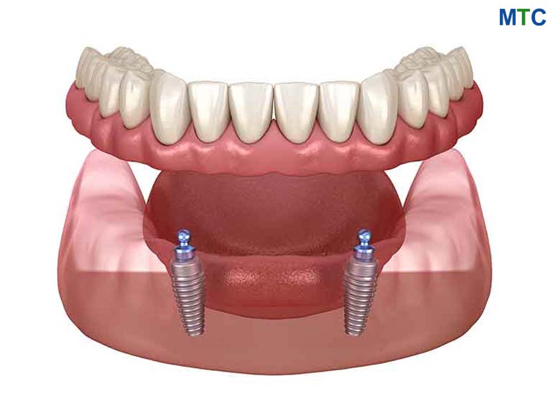 Snap-on Dentures