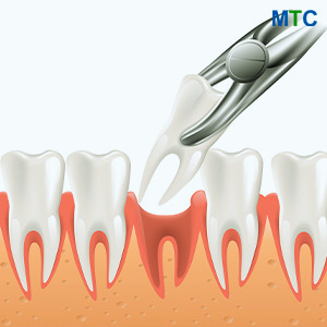 Tooth Extraction