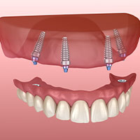 All on 4 dental implants in Casablanca, Morocco