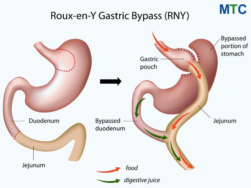Gastric Bypass Surgery in Mexico Procedure