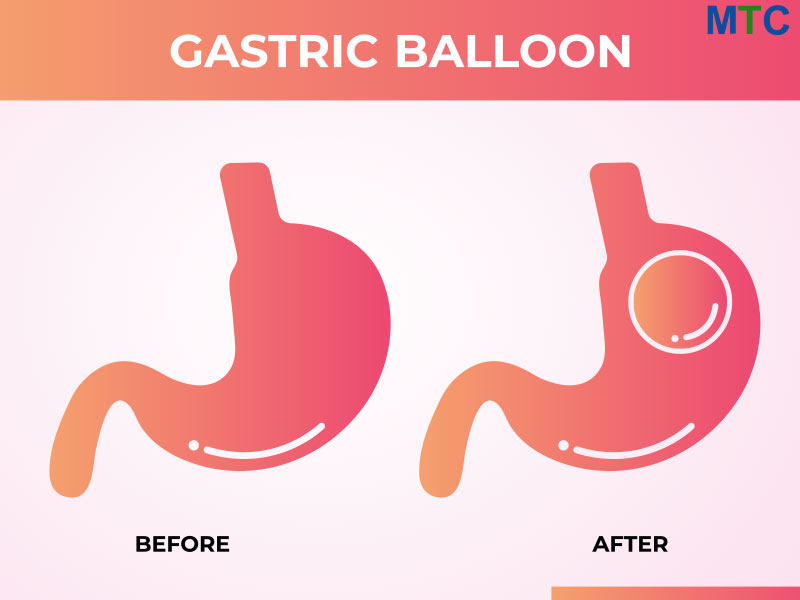 Gastric Balloon