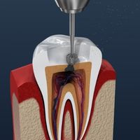 Endodoncia