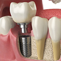 Dental Implant