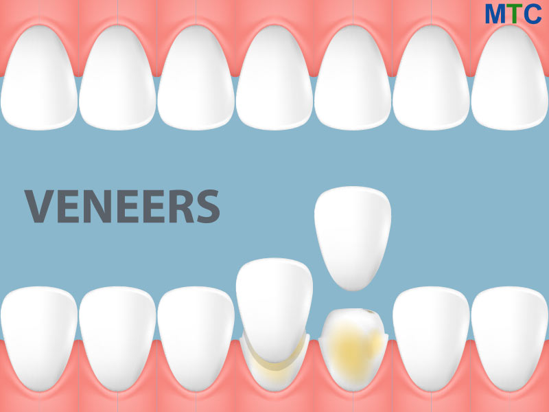 Dental Veneers in India