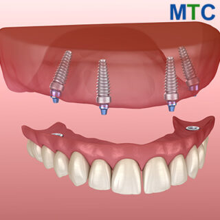 All on four dental implants in Costa Rica