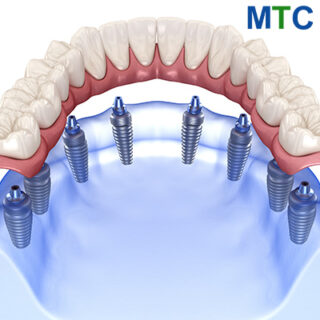 All on 8 dental implants in Vietnam