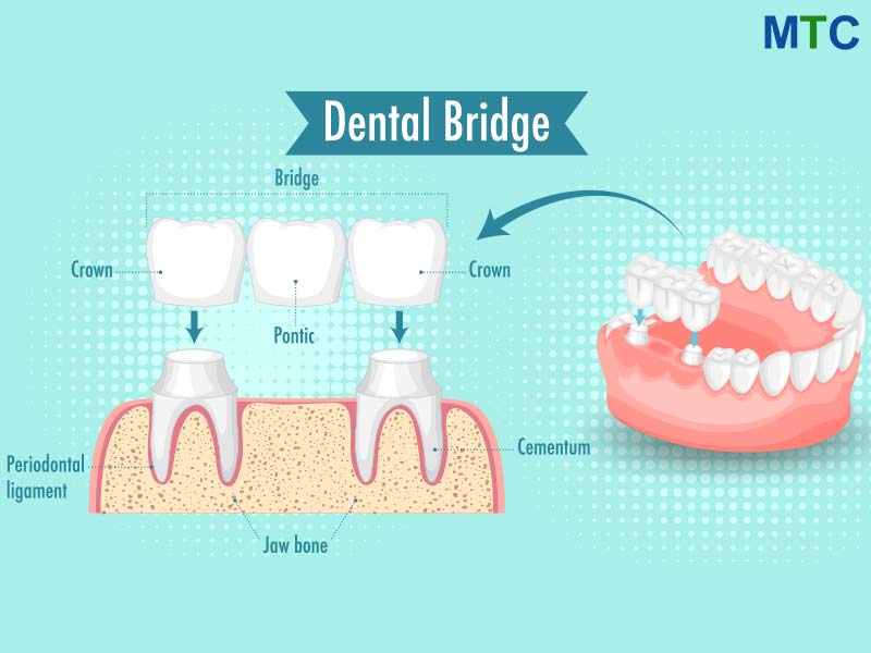 Dental Bridge in Cancun