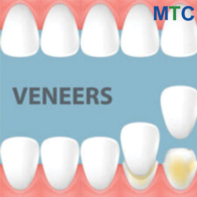 Dental Veneers in Costa Rica