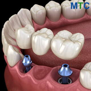 Implant supported bridge in Mazatlan