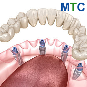 All on 4 dental implants in Hanoi