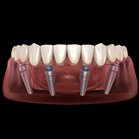 All on 4 Dental Implants in Mexico