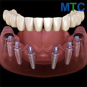 All on 6 dental implants in Crete, Greece