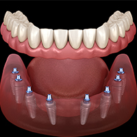 All-on-8 Implants | Izmir, Turkey