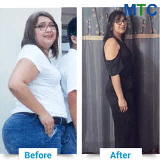 Bariatric surgery in Nuevo Laredo - Before & after