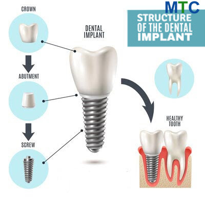 Structure of dental implant