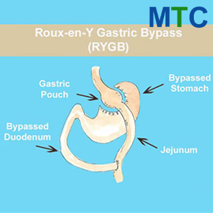 Gastric Bypass