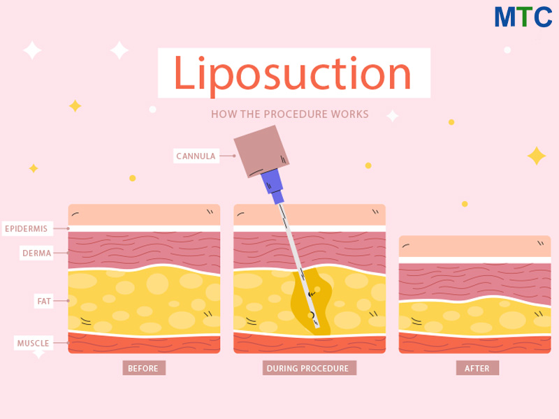 Liposuction Procedure