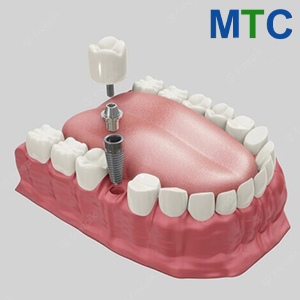 Single dental implants in Guatemala City