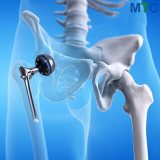 Hip Replacement Implant 