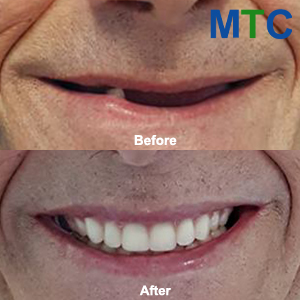 Before & After: All-on-4 Dental Implants Abroad