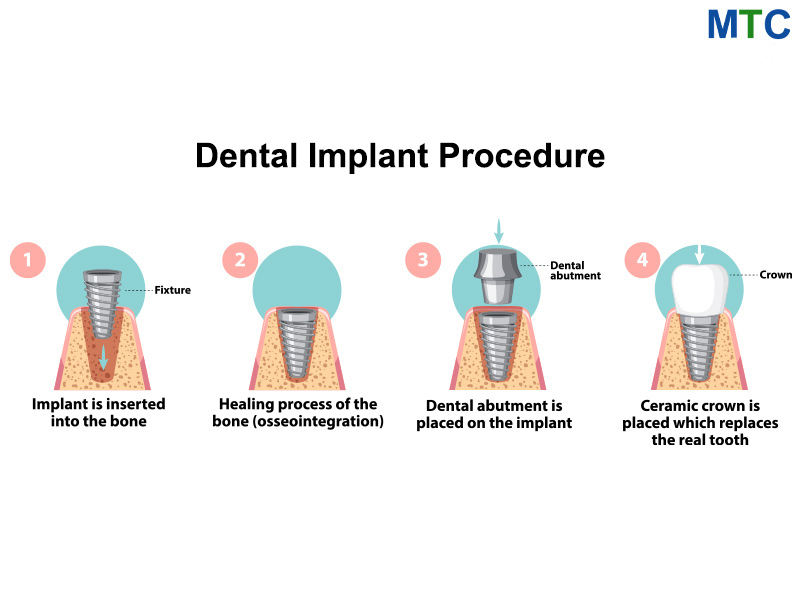 Dental Implant Procedure