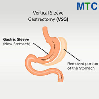 Gastric Sleeve Procedure