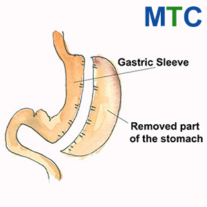 Gastric sleeve surgery in Puerto Vallarta