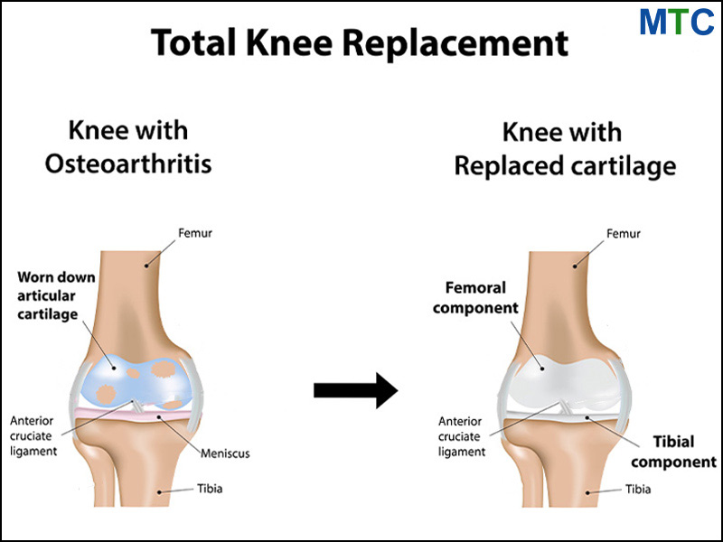 Total knee replacement surgery