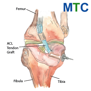 ACL Reconstruction in Istanbul, Turkey 