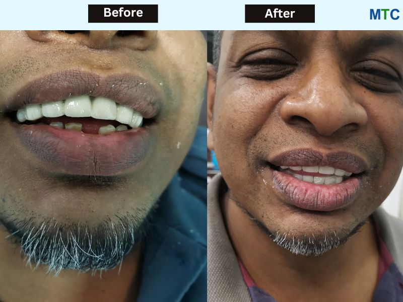 Before & After Dental Implants in Sri Lanka