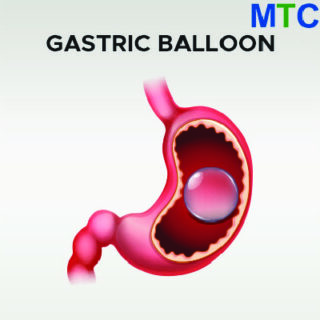 Gastric Balloon Procedure