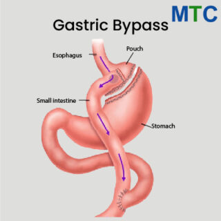 Gastric Bypass Procedure