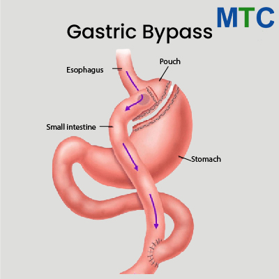 Gastric Bypass, Bursa