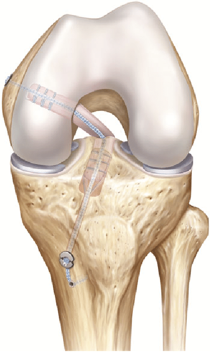 PCL Graft