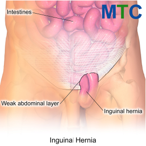 Inguinal Hernia Repair Los Algodones, Mexico