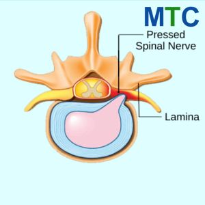 Spinal Fusion