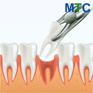 Tooth Extraction